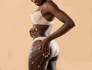 Illustration of BBL treatment areas on a beautiful woman