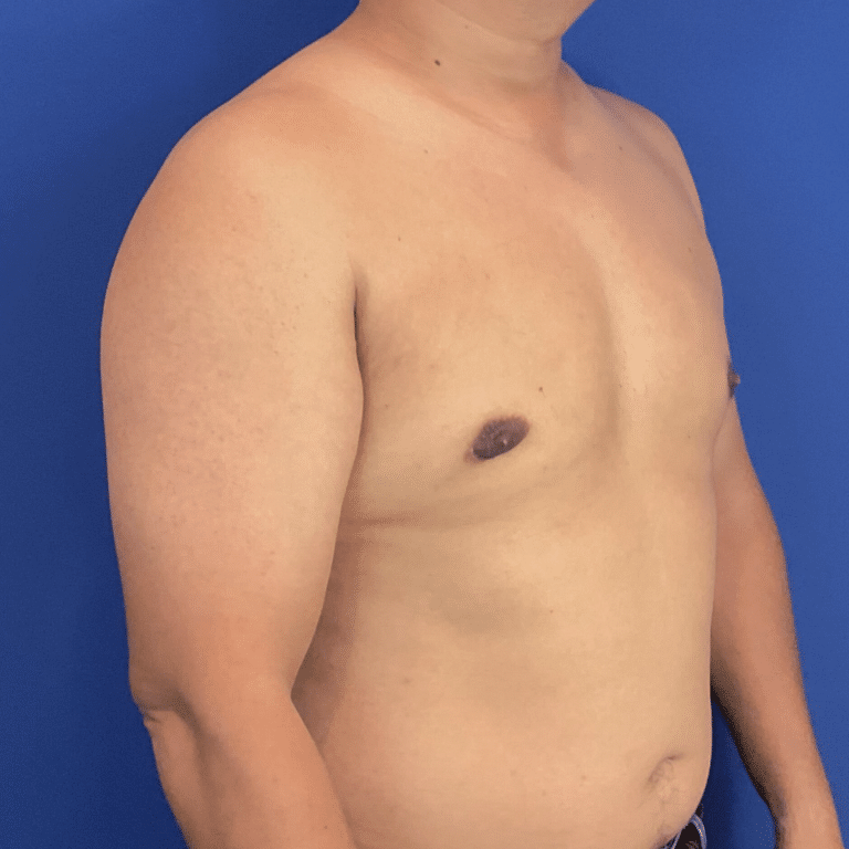 After Image: Patient Case #6432 - right-front-oblique
