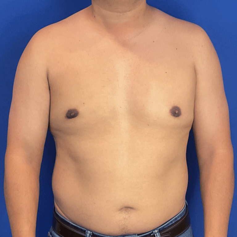 After Image: Patient Case #6432 - front