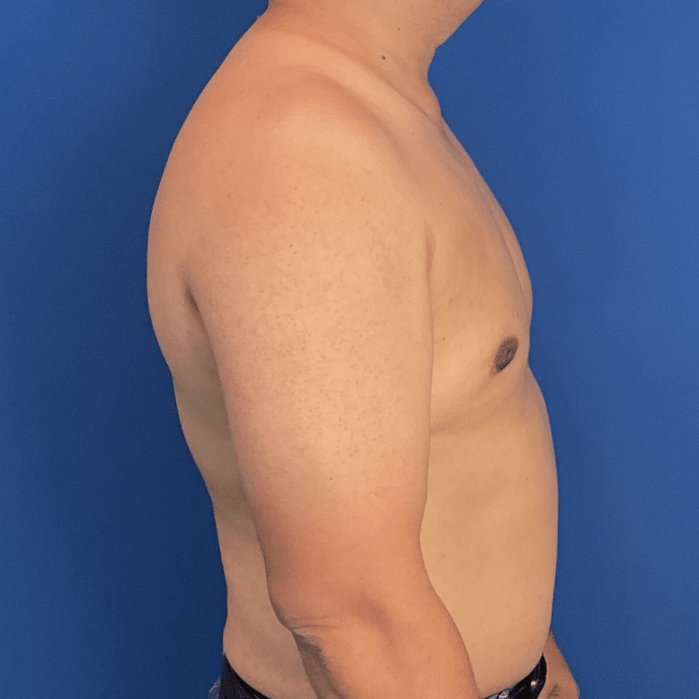 After Image: Patient Case #6432 - right-side