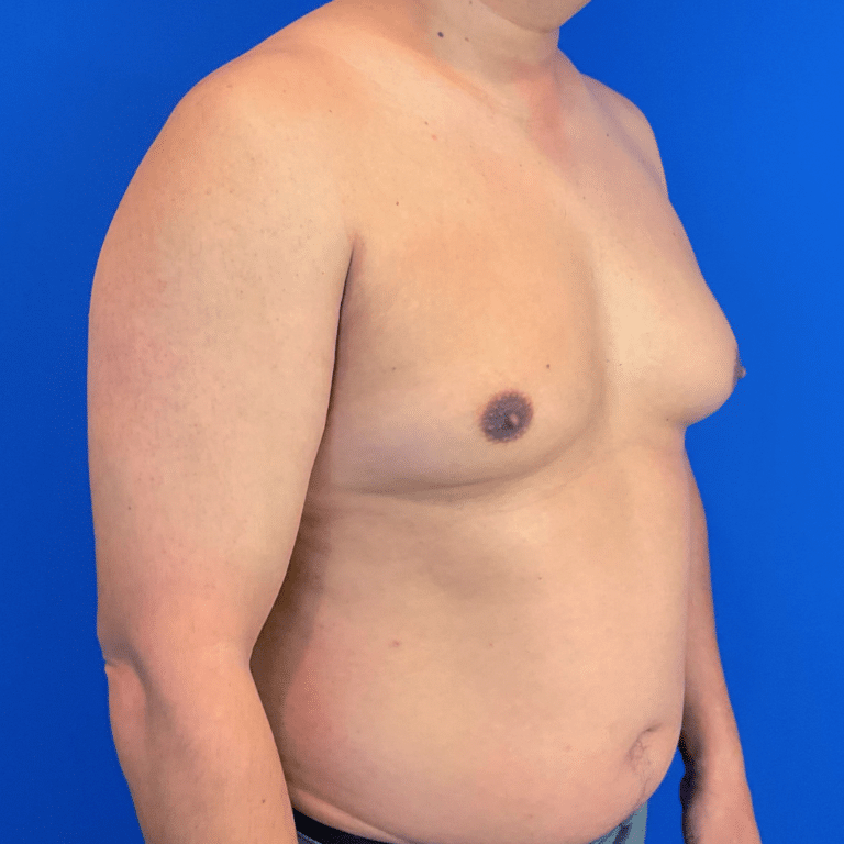 Before Image: Patient Case #6432 - right-front-oblique