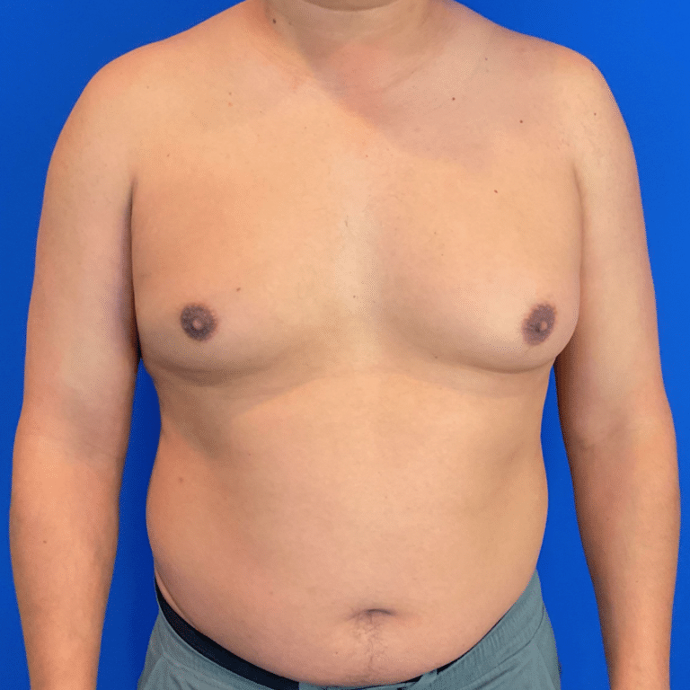 Before Image: Patient Case #6432 - front