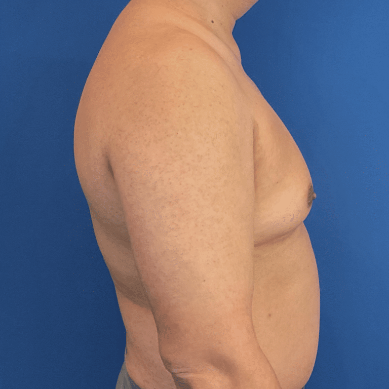 Before Image: Patient Case #6432 - right-side