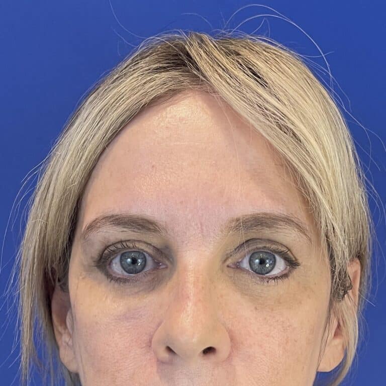 After Image: Patient Case #6820 - front