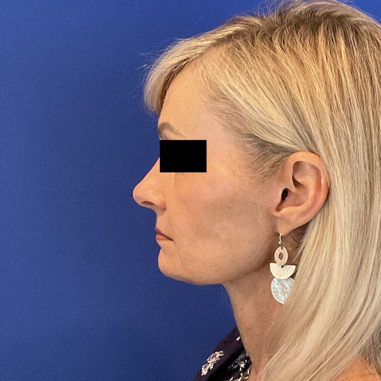 After Image: Patient Case #6839 - left-side