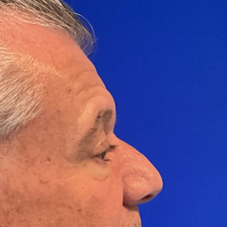 Before Image: Patient Case #3531 - right-side