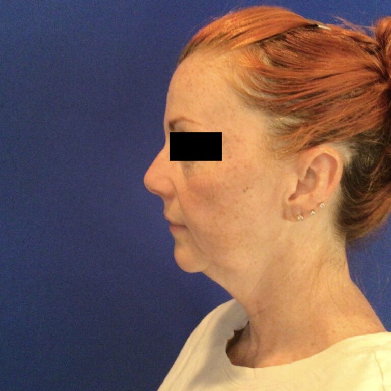 Before Image: Patient Case #6767 - left-side