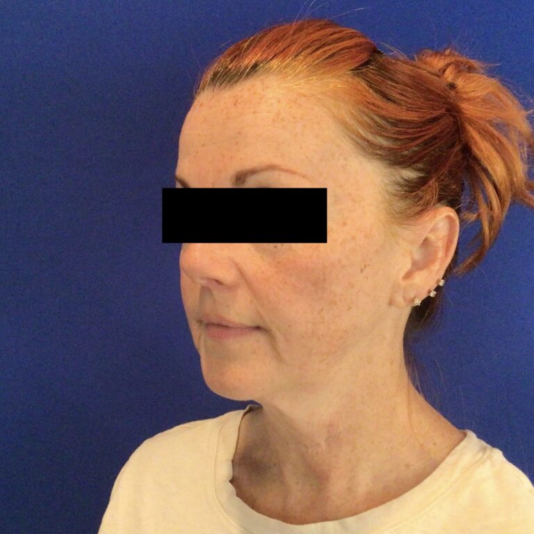 Before Image: Patient Case #6767 - left-front-oblique