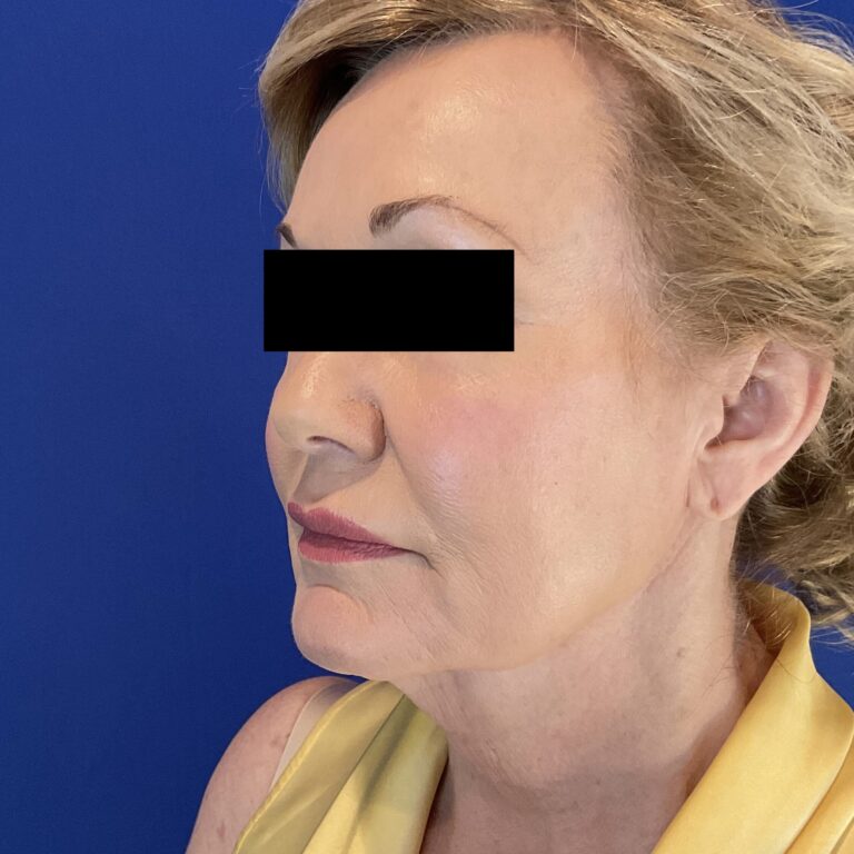 Before Image: Patient Case #6846 - left-front-oblique