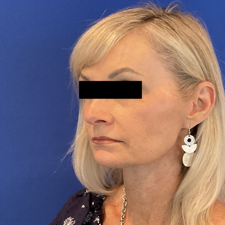 After Image: Patient Case #6839 - left-front-oblique