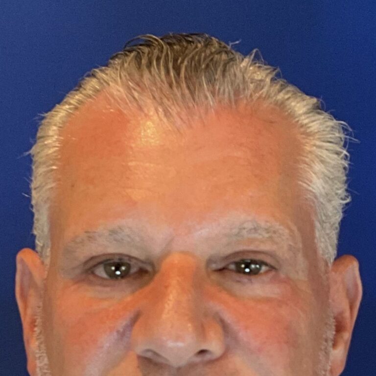 After Image: Patient Case #3531 - front