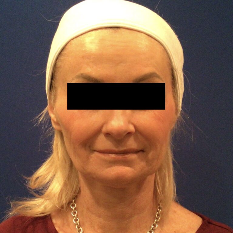 Before Image: Patient Case #6839 - front