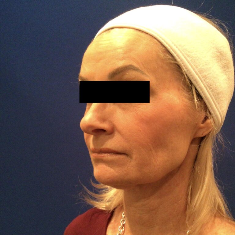 Before Image: Patient Case #6839 - left-front-oblique