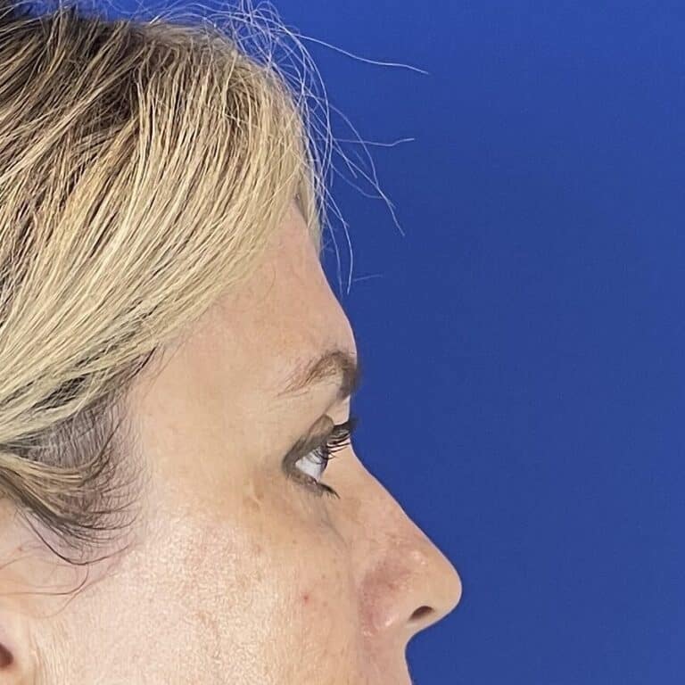 After Image: Patient Case #6820 - right-side