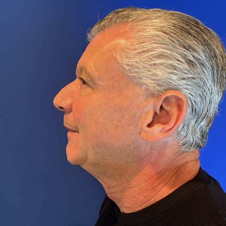 Before Image: Patient Case #3641 - left-side