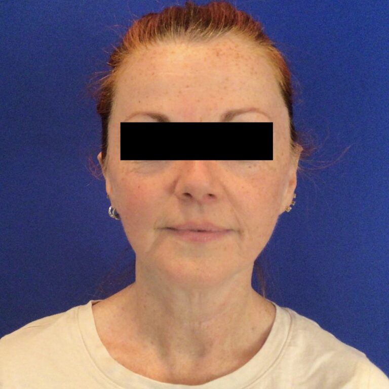 Before Image: Patient Case #6767 - front
