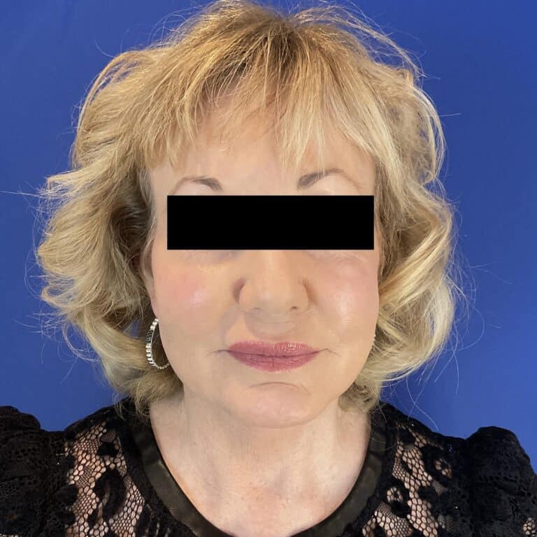 After Image: Patient Case #6846 - front