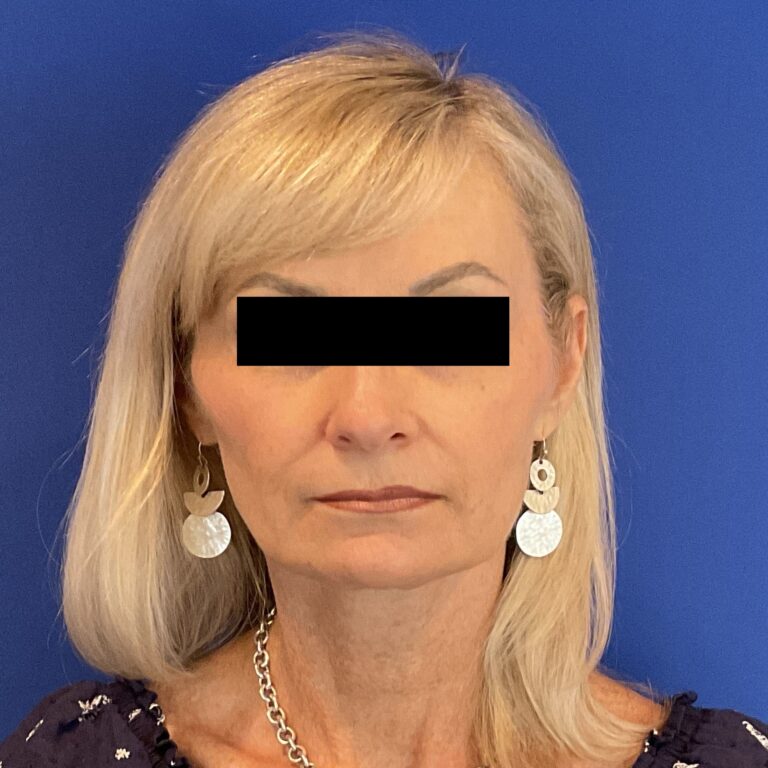 After Image: Patient Case #6839 - front