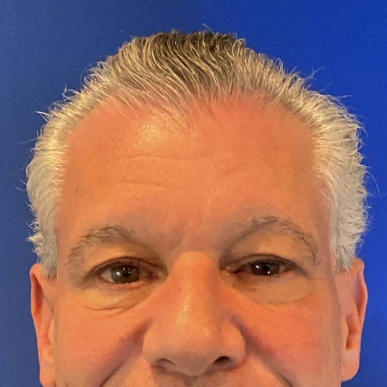 Before Image: Patient Case #3531 - front