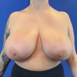 Before Image: Patient Case #4854