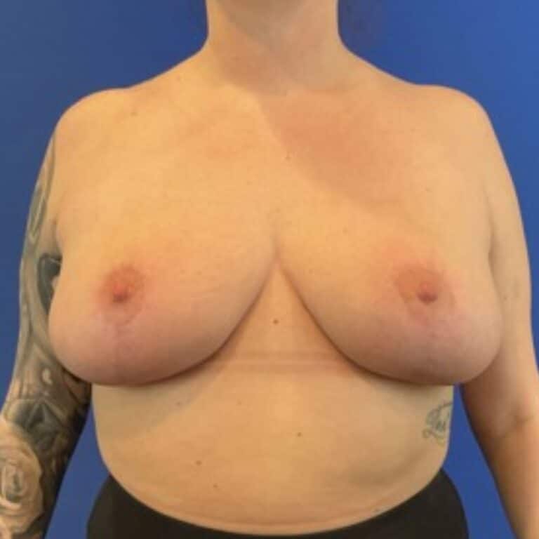 After Image: Patient Case #4854 - front