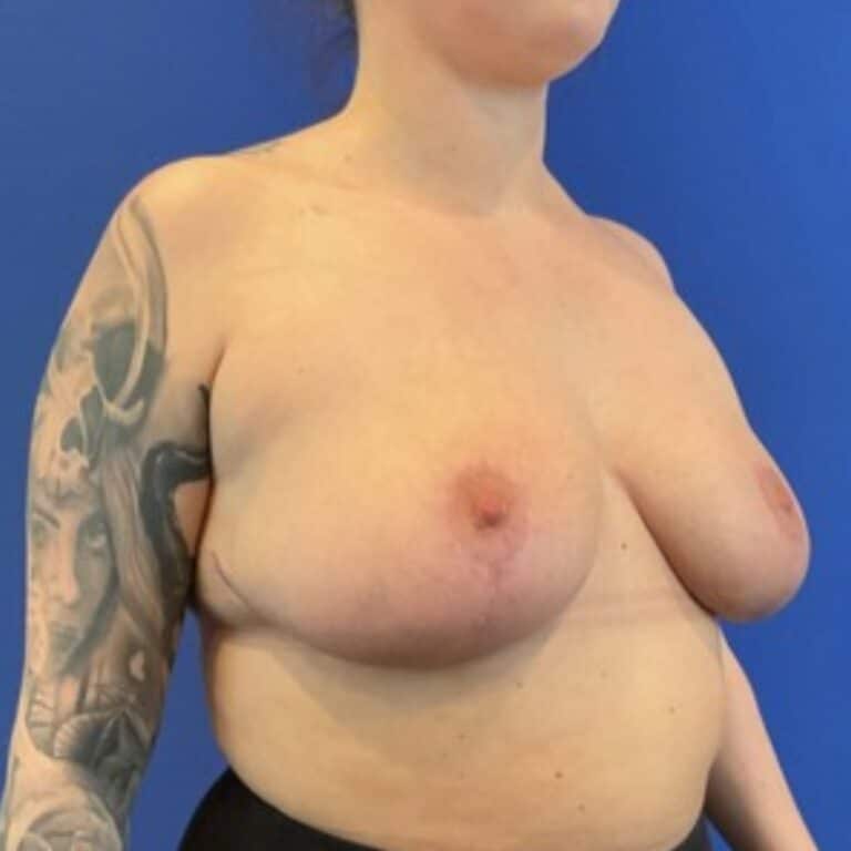 After Image: Patient Case #6746 - right-front-oblique