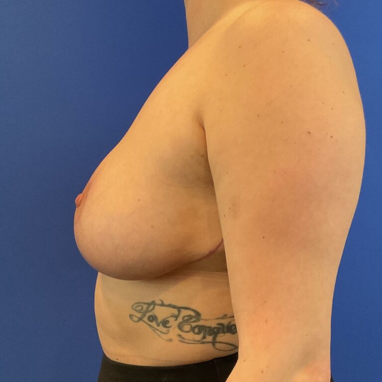 After Image: Patient Case #6746 - front