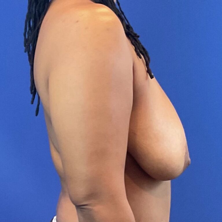 Before Image: Patient Case #6774 - front