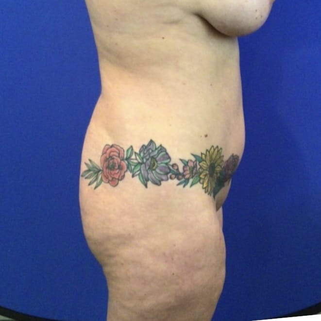 Before Image: Patient Case #6856 - right-side