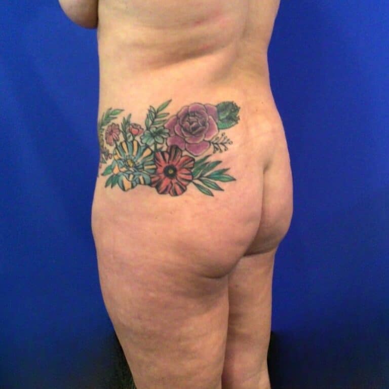 Before Image: Patient Case #6856 - left-back-oblique