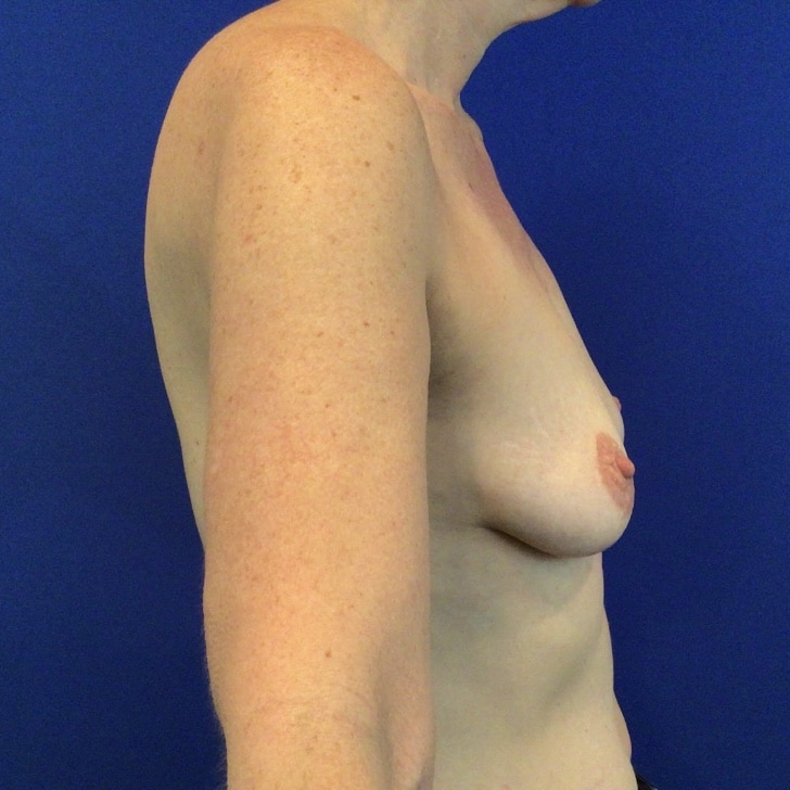 Before Image: Patient Case #6863 - right-side