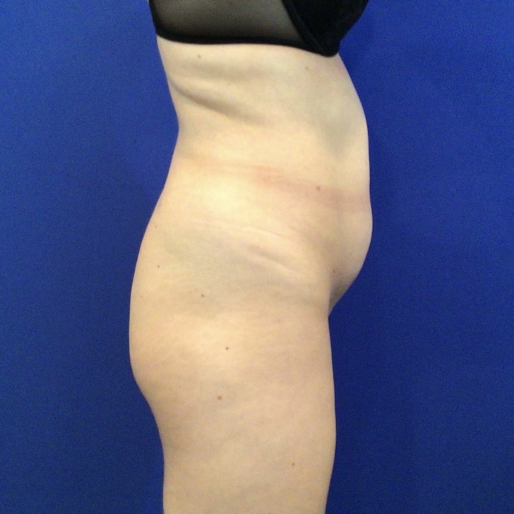 Before Image: Patient Case #6875 - right-side