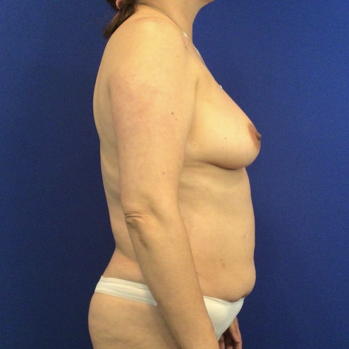 Before Image: Patient Case #6892 - right-side