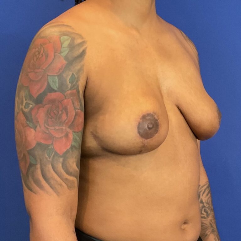 After Image: Patient Case #6899 - right-front-oblique