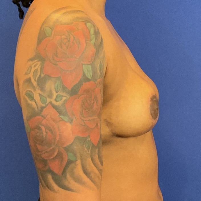 After Image: Patient Case #6899 - right-side