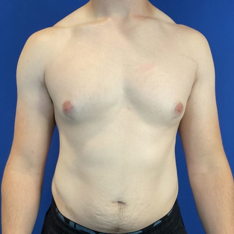 Before Image: Patient Case #6936 - front