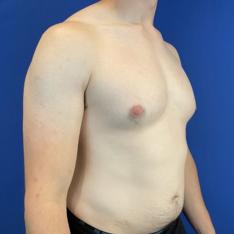 Before Image: Patient Case #6936 - front