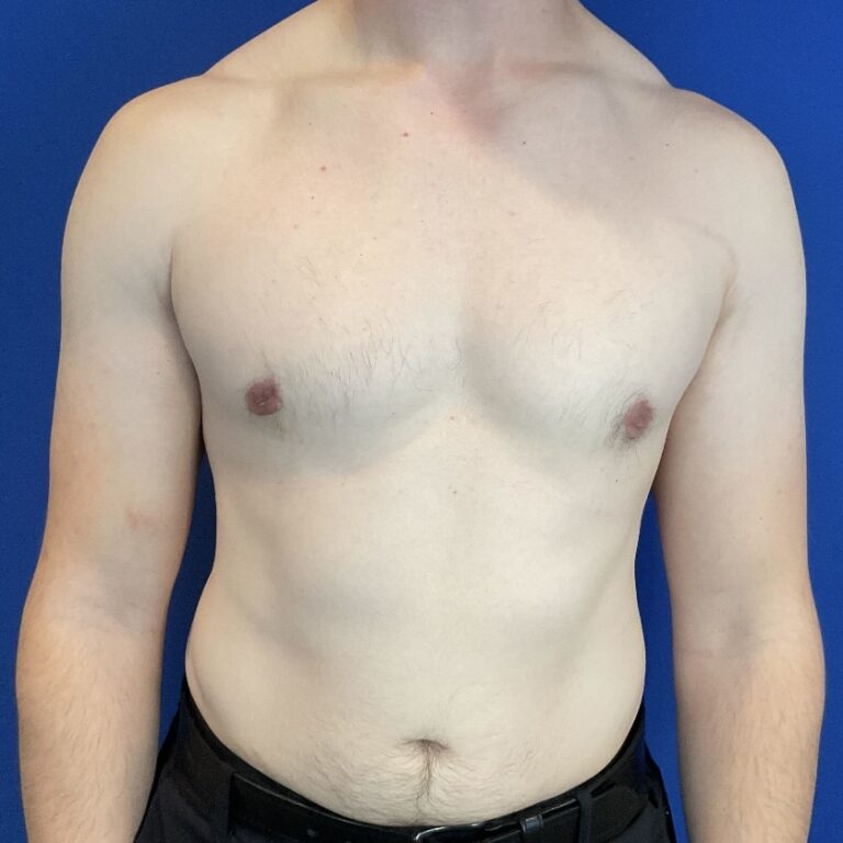 After Image: Patient Case #6936 - front