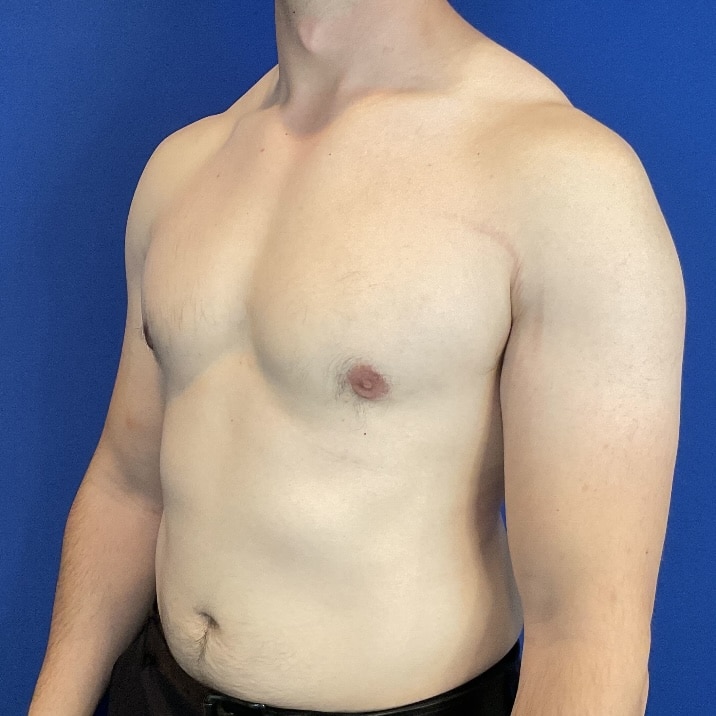 After Image: Patient Case #6936 - left-front-oblique