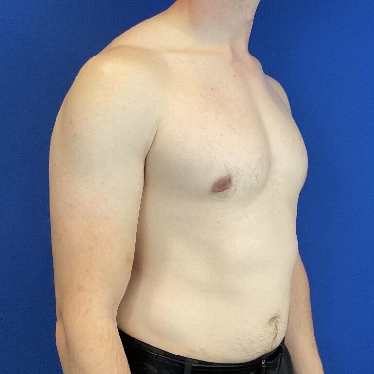 After Image: Patient Case #6936 - front