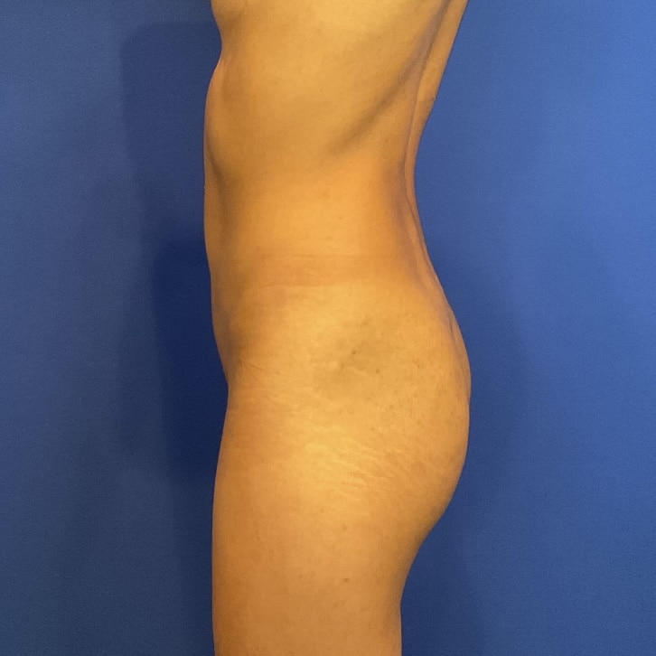 Before Image: Patient Case #6951 - left-side
