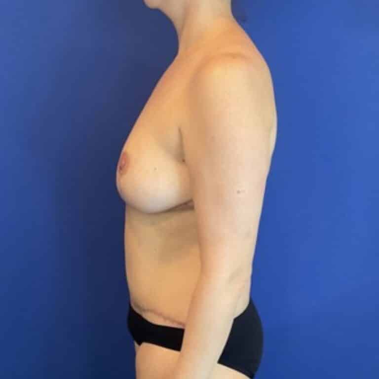 After Image: Patient Case #6970 - left-side