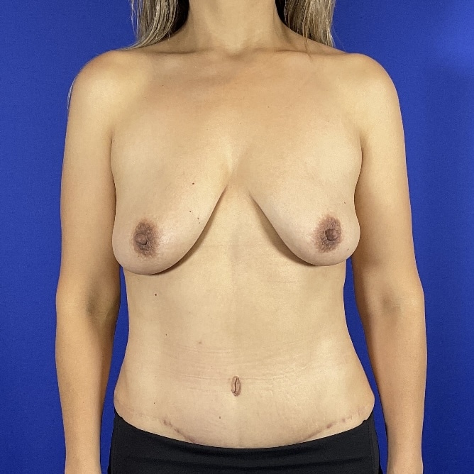 After Image: Patient Case #7006 - front