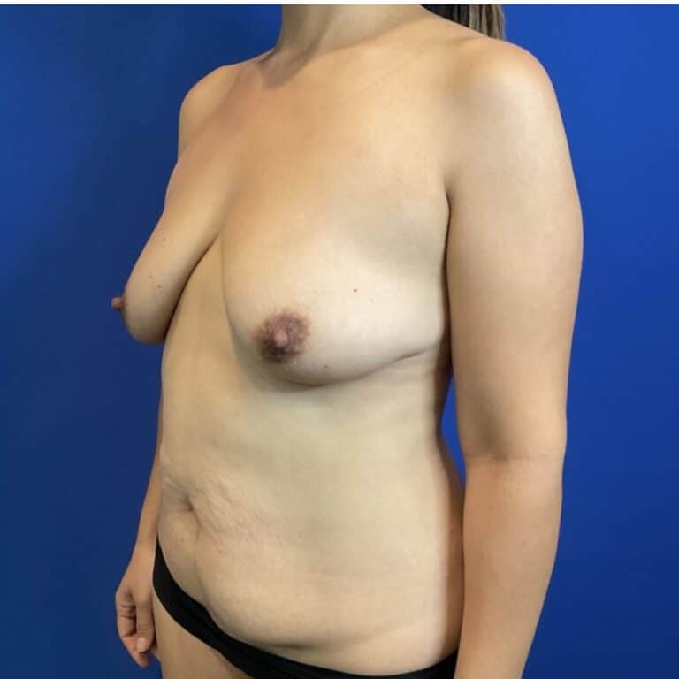Before Image: Patient Case #7006 - left-front-oblique