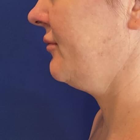 Before Image: Patient Case #7016 - left-side