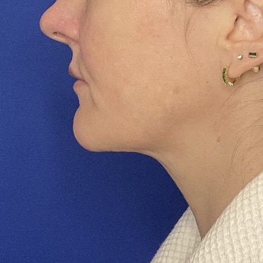 After Image: Patient Case #7016 - left-side