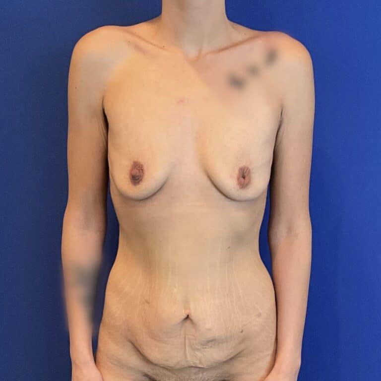 Before Image: Patient Case #7028 - front