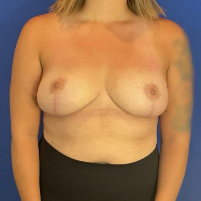 After Image: Patient Case #7033 - front