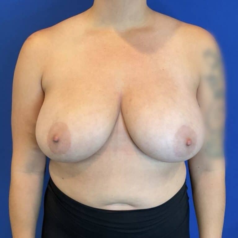 Before Image: Patient Case #7033 - front