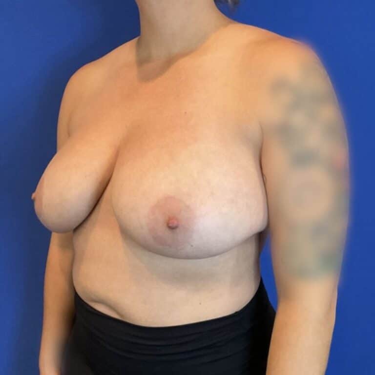 Before Image: Patient Case #7033 - left-front-oblique